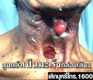 Thailand 2009 Health Effects other - lived experience, throat cancer, gross.jpg