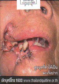 Thailand-2014-Health-Effects-mouth-mouth-cancer-gross.jpg